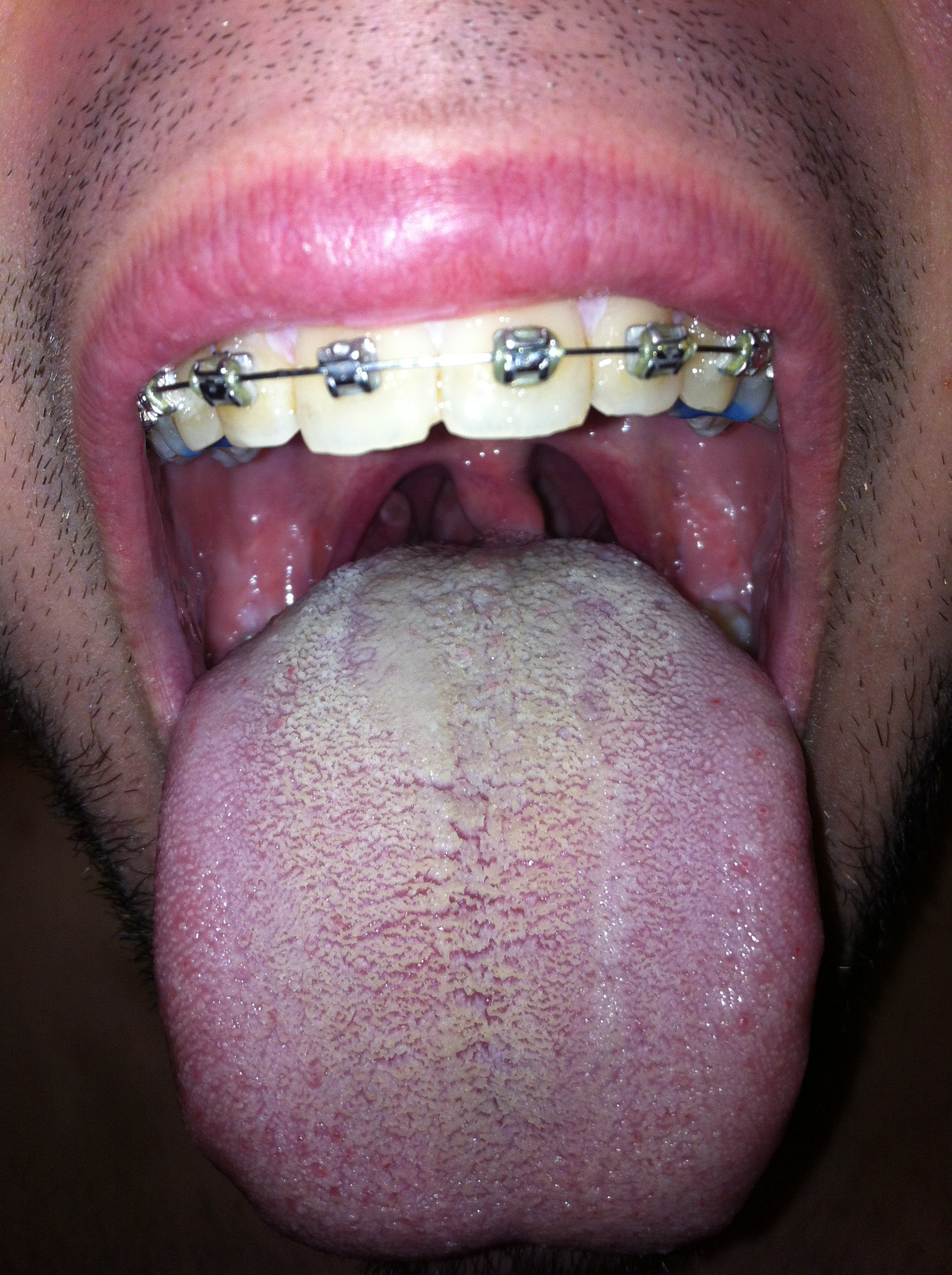 Witte aanslag tong gaat niet weg